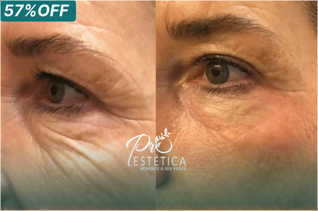 Rugas ao redor dos olhos