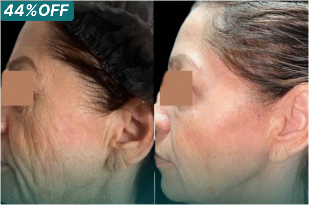 Rejuvenescimento facial antes e depois