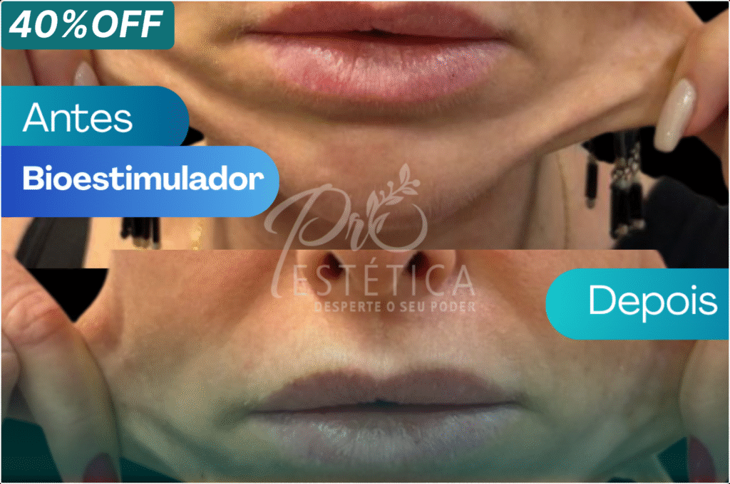 Lábios bioestimulador