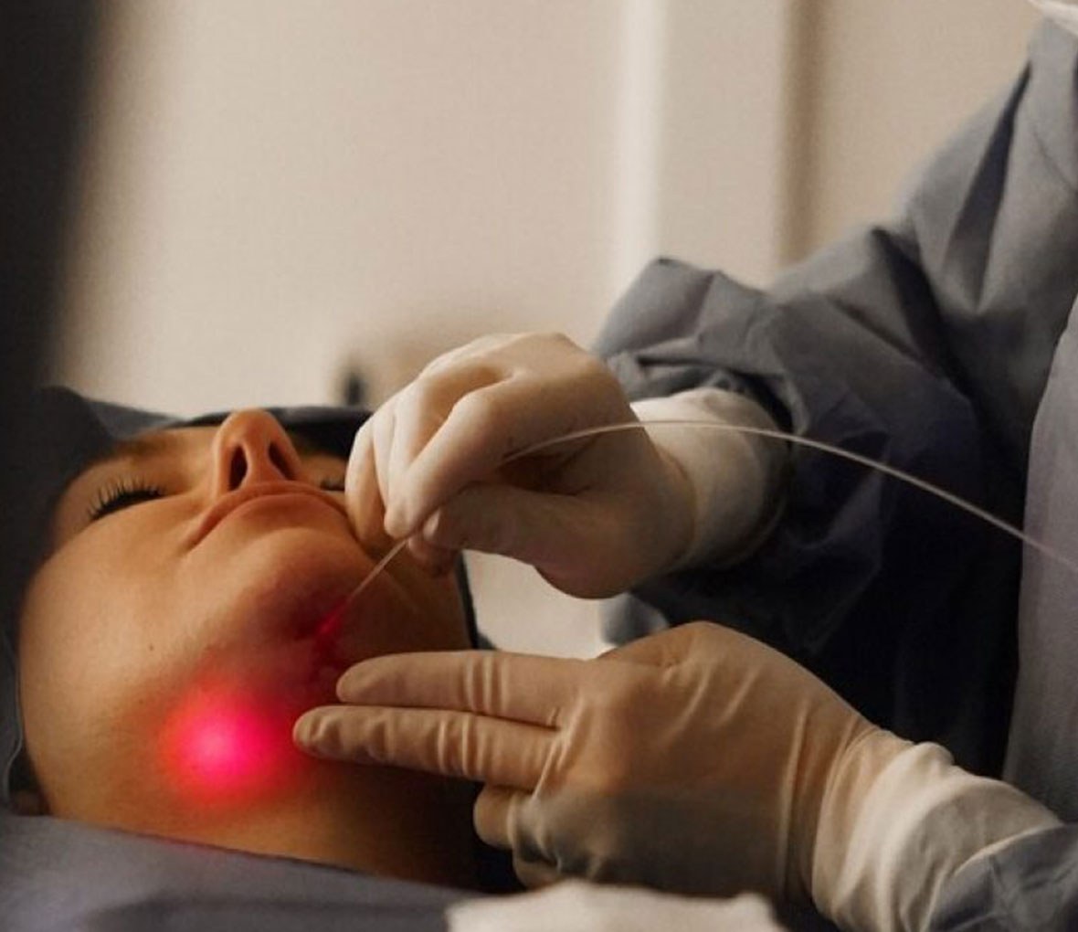 Endolaser — firmeza facial